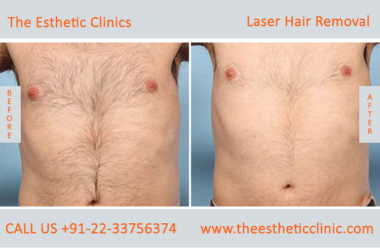 Permanent Laser Hair Removal Treatment before after photos in mumbai india (4)
